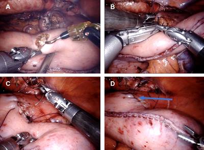 Robot-assisted esophagectomy may improve perioperative outcome in patients with esophageal cancer – a single-center experience